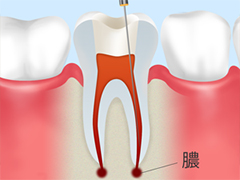歯の根っこの治療～根管治療～