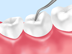 歯周内科治療
